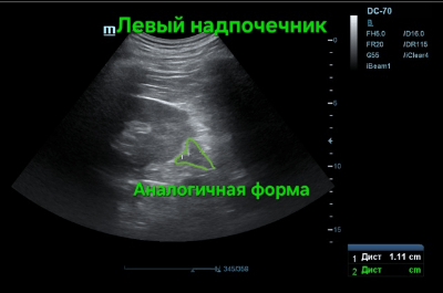Левый надпочечник